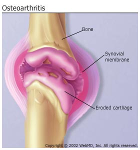 http://velosamara.ru/article/knees/Osteoarthritis.jpg